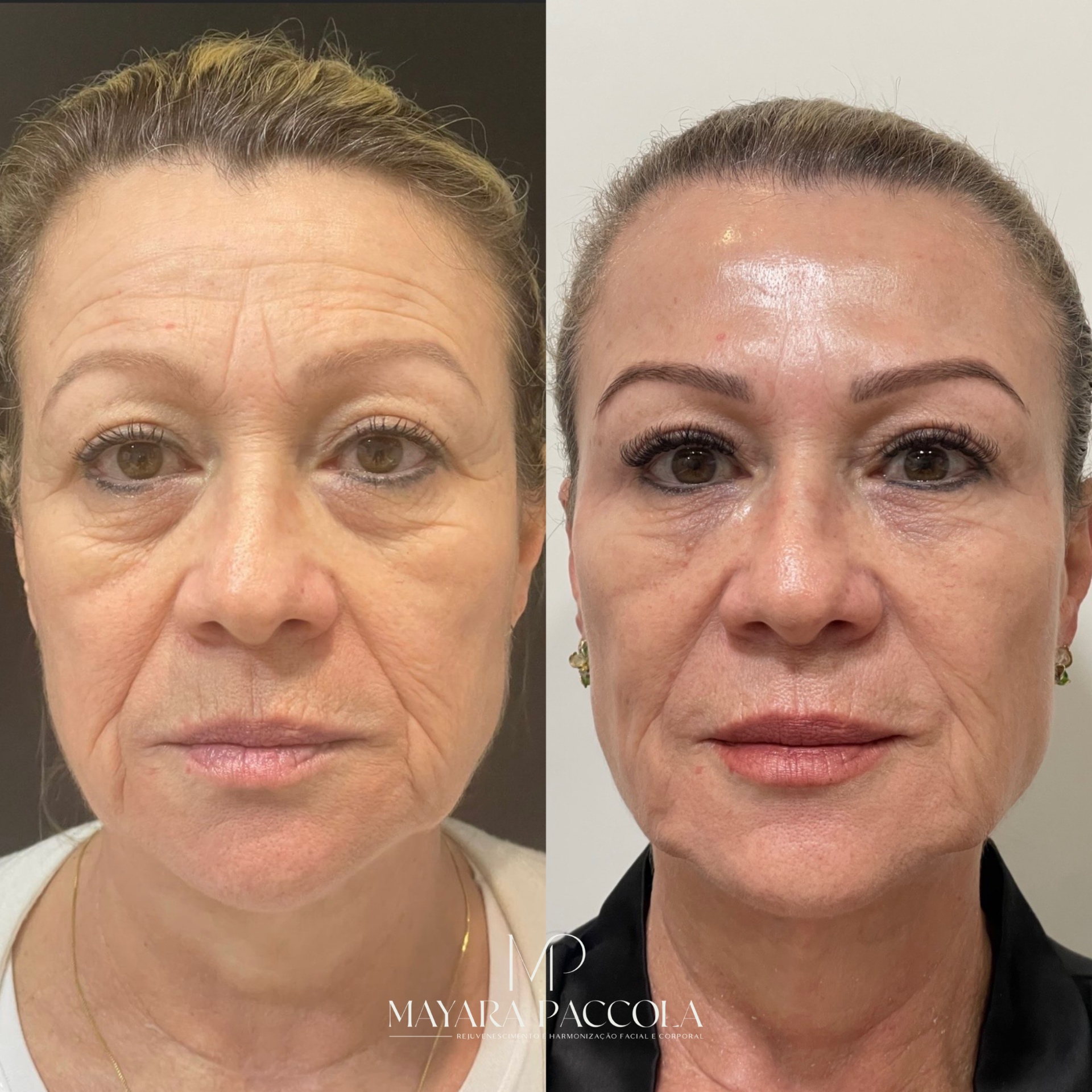 Antes e depois de rejuvenescimento e viço da pele