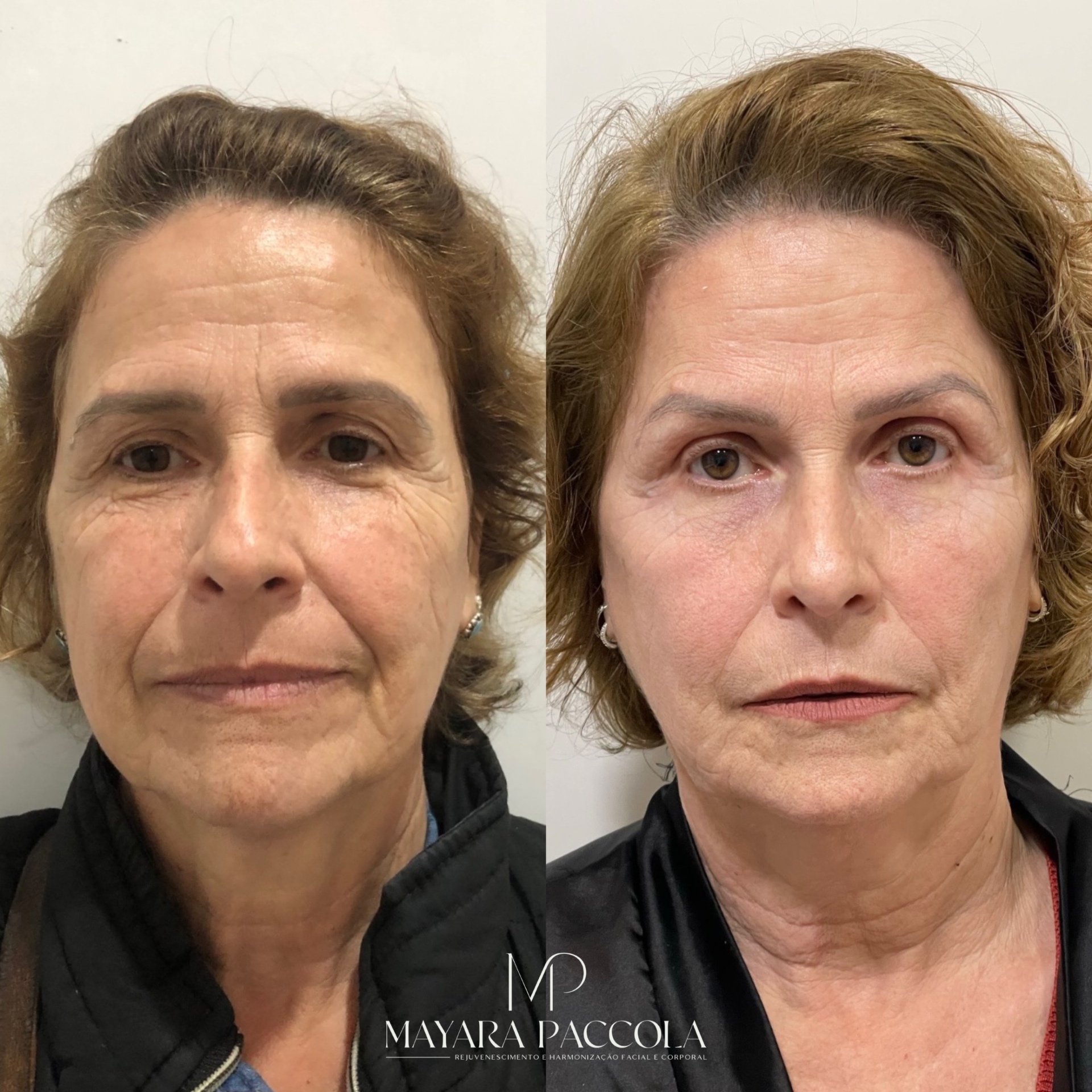 Antes e depois de tratamento de flacidez facial
