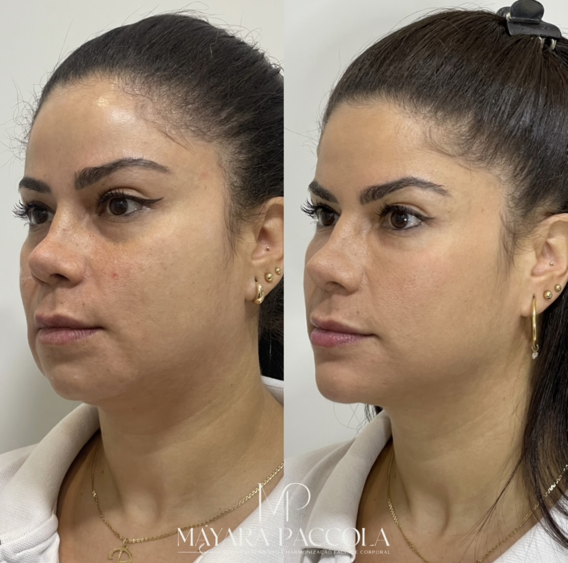 Antes e depois de contorno e definição facial
