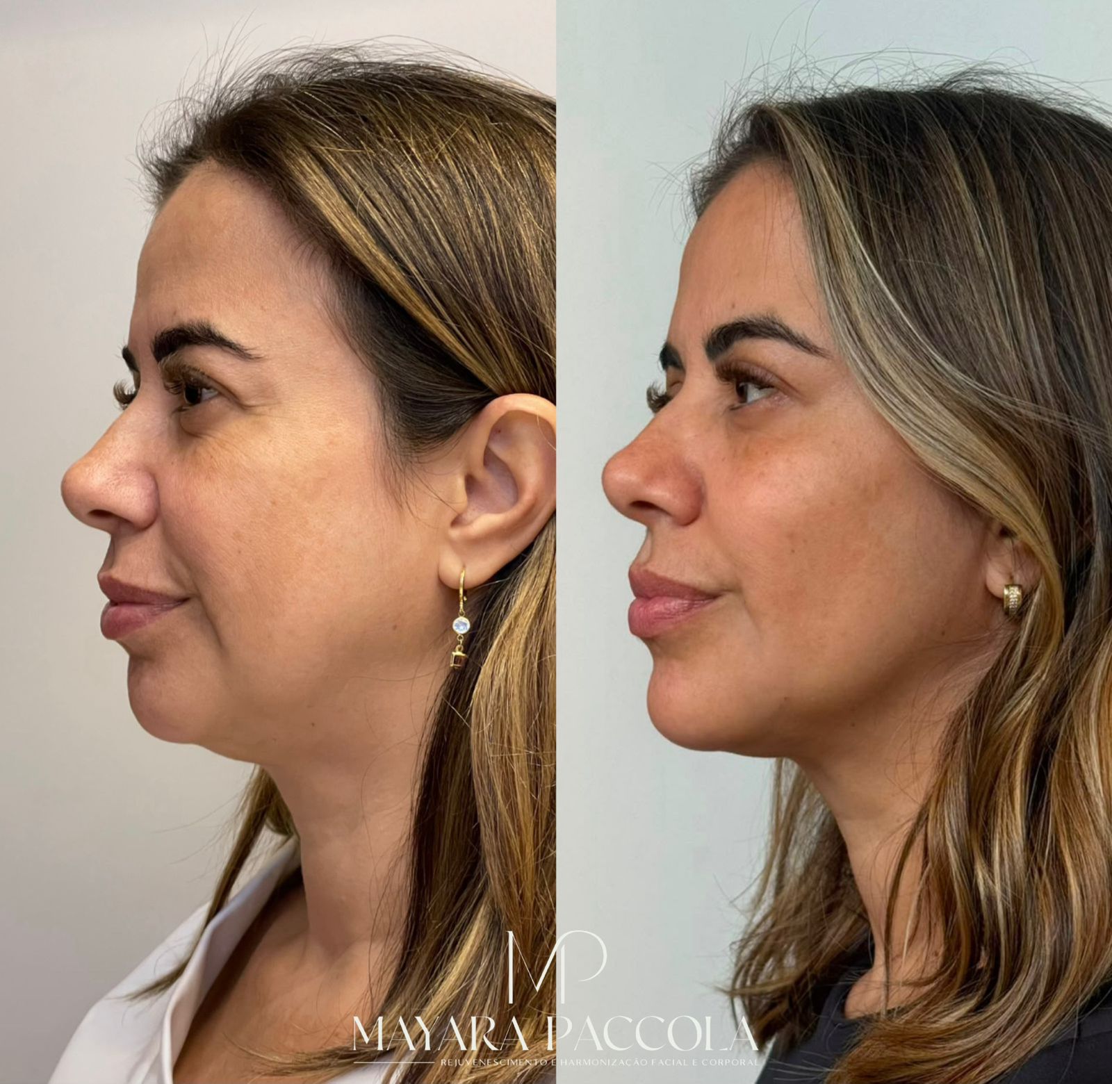Antes e depois de harmonização facial de perfil