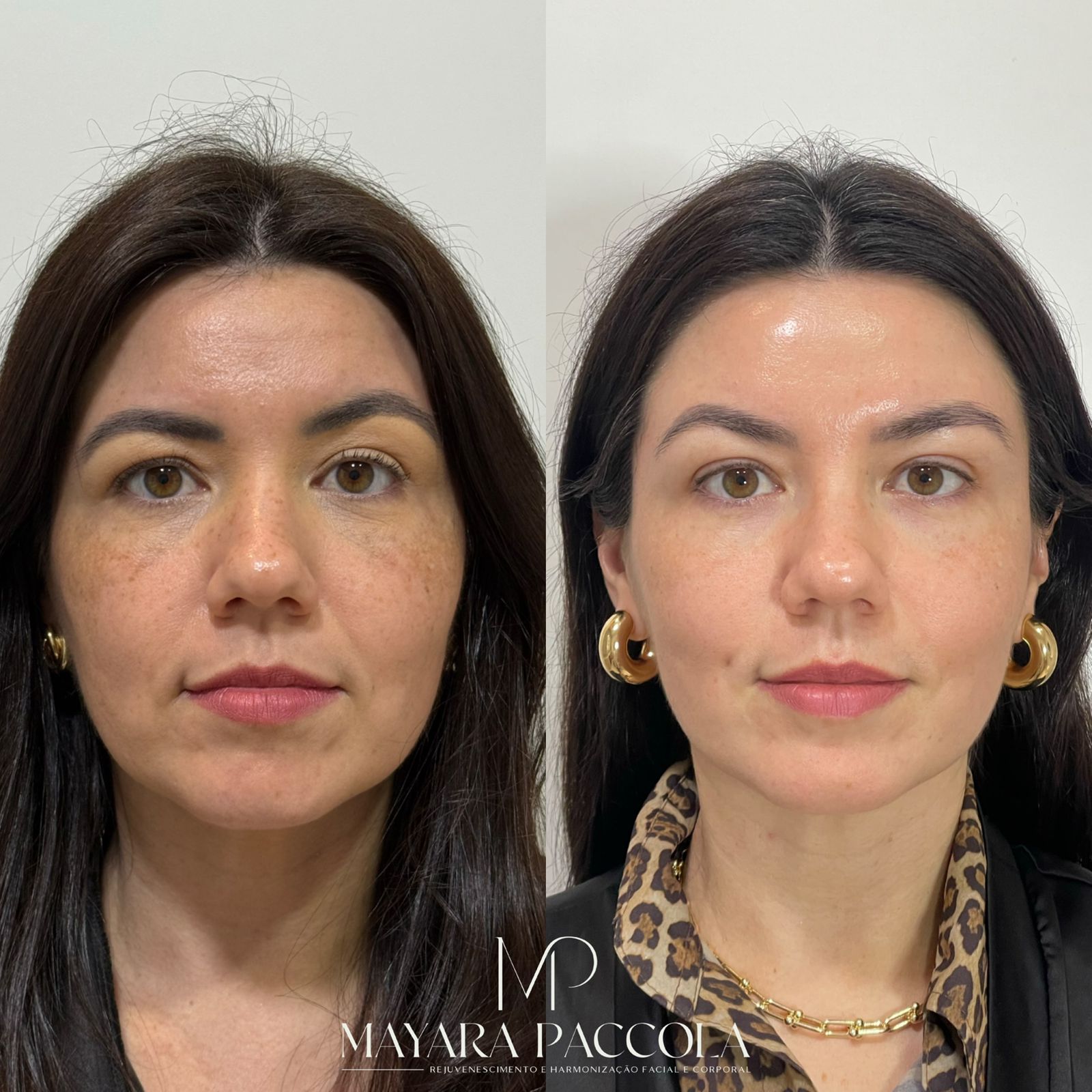 Antes e depois de rejuvenescimento facial