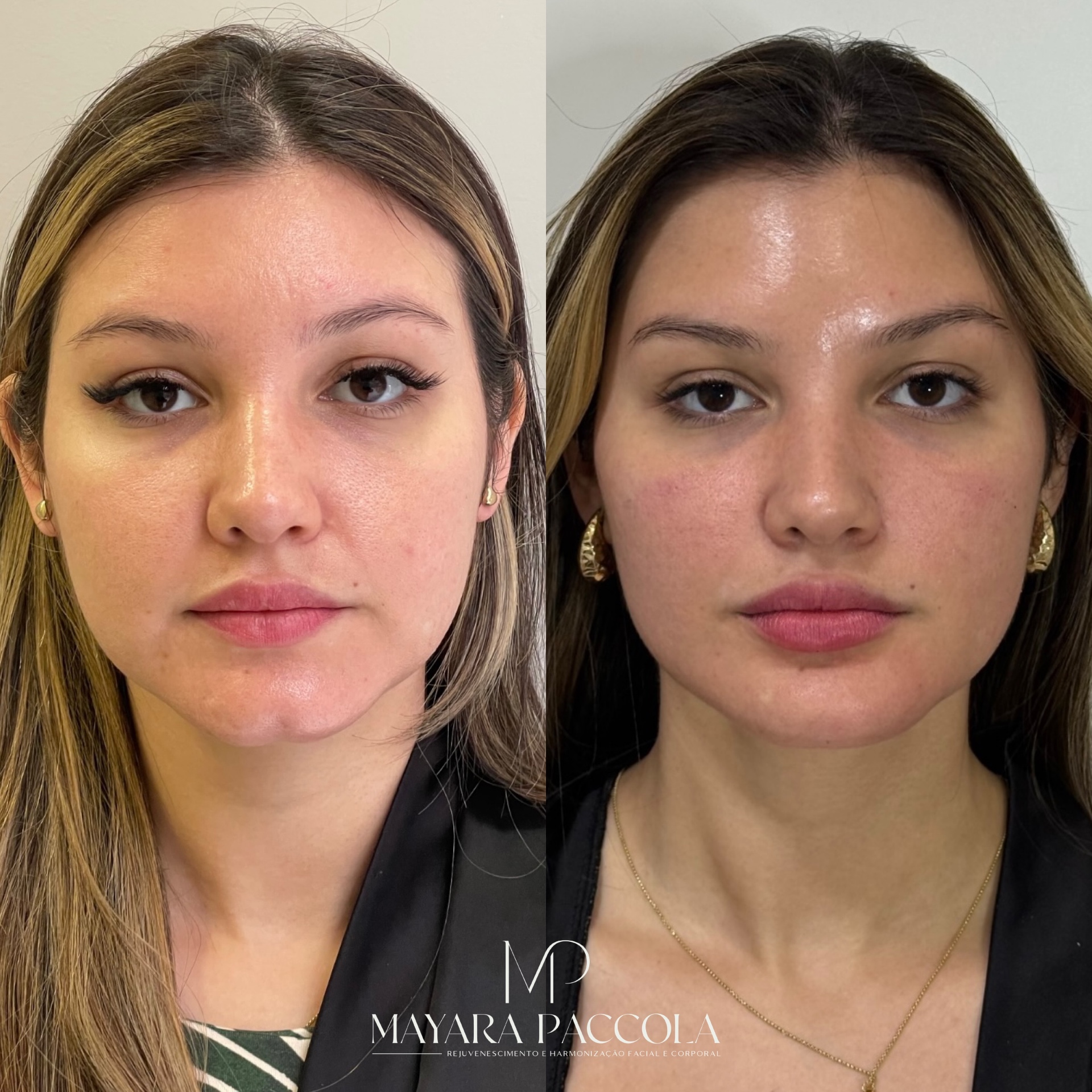 Antes e depois de tratamento estético facial